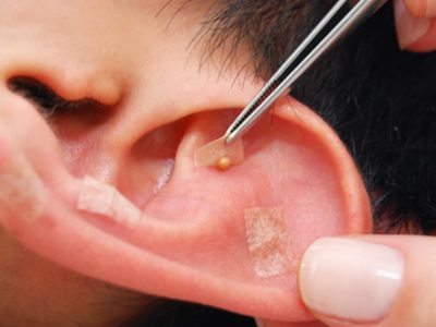 Auriculoterapia-12 Auriculoterapia Técnica Chinesa – EAD